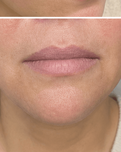Cosmetic Tattoo Removal: after