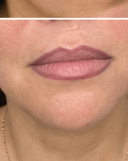 Cosmetic Tattoo Removal: before