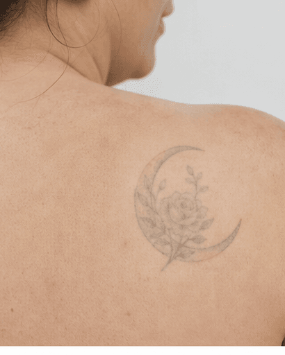 Post-Tattoo Scar Treatment: after