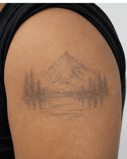 Post-Tattoo Scar Treatment: after