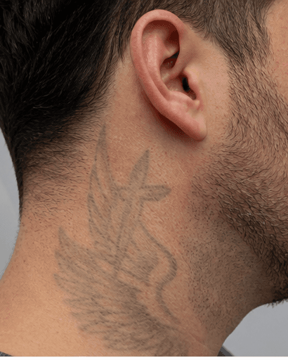 Tattoo Fading for Cover-Up: after