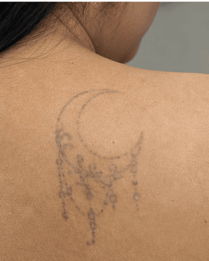 Tattoo Fading for Cover-Up: after