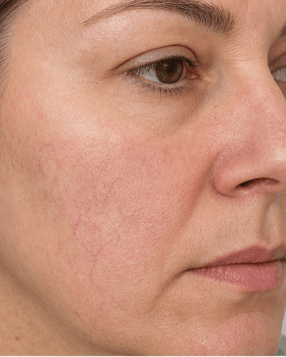 Facial Thread Veins: after
