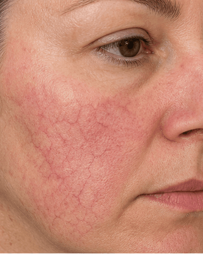 Facial Thread Veins: before