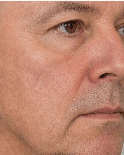 Facial Thread Veins: after