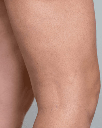 Leg Spider Veins: after