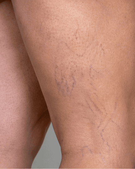 Leg Spider Veins: before