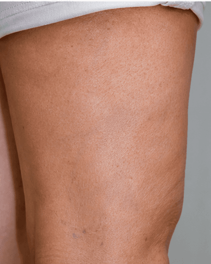 Leg Spider Veins: after