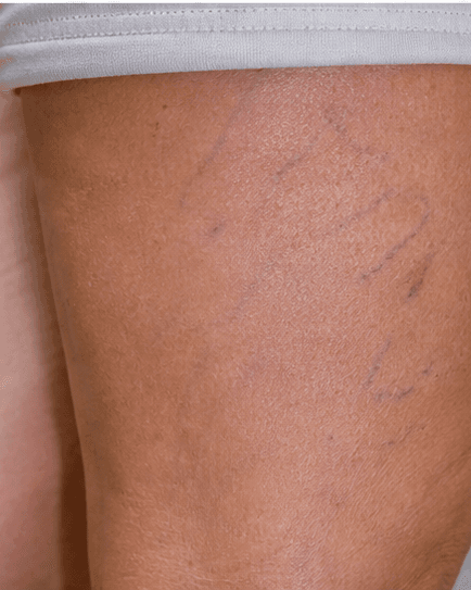 Leg Spider Veins: before