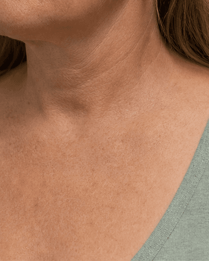 Neck & Chest Redness: after