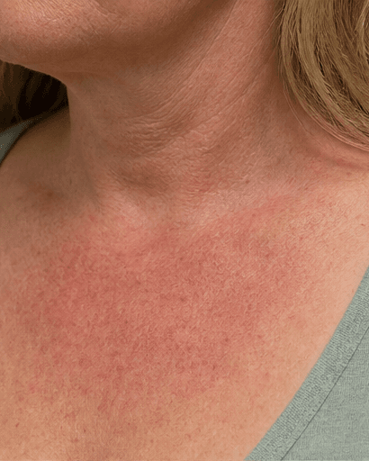 Neck & Chest Redness: before
