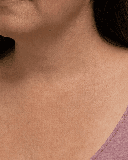 Neck & Chest Redness: after