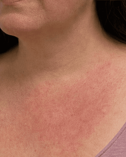 Neck & Chest Redness: before