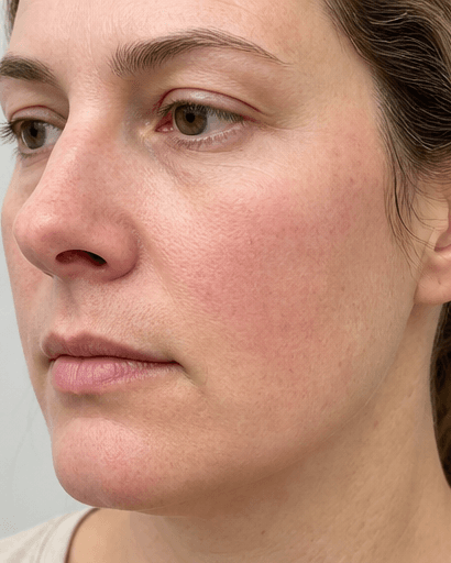 Rosacea Vessel Treatment: after