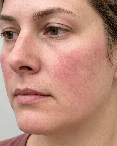 Rosacea Vessel Treatment: before