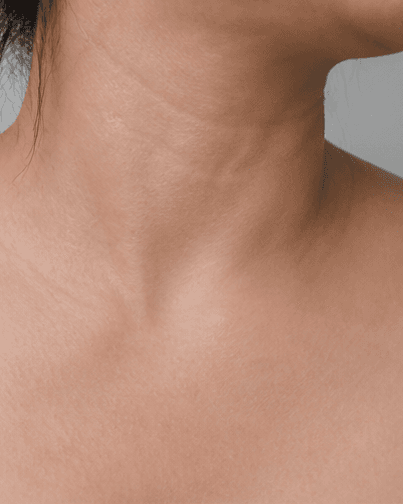 Intimate Pigmentation Care: after