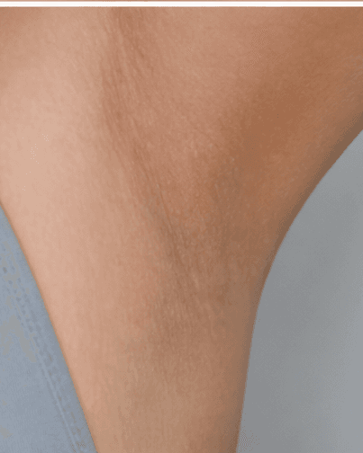 Intimate Pigmentation Care: after