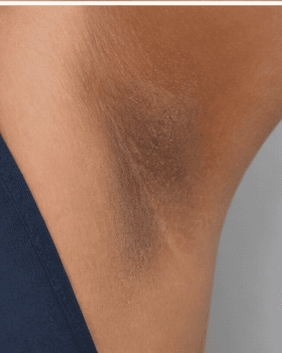 Intimate Pigmentation Care: before