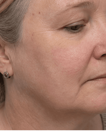Lichen Sclerosus Management: after