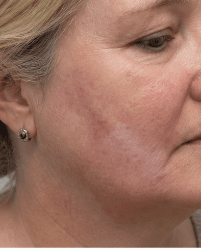 Lichen Sclerosus Management: before