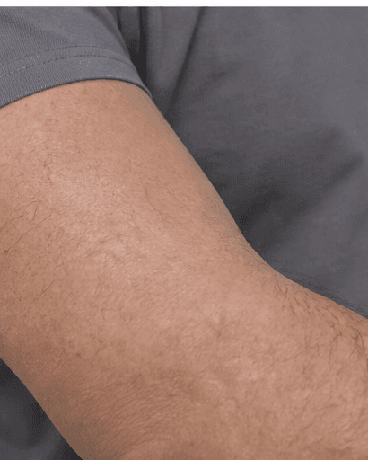 Lichen Sclerosus Management: after
