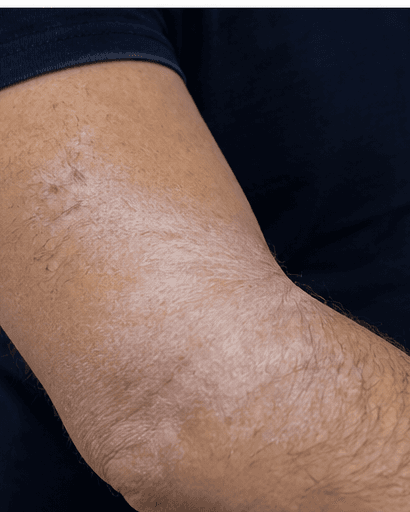 Lichen Sclerosus Management: before