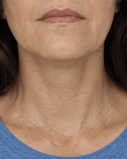 Intimate Laser Therapy: after
