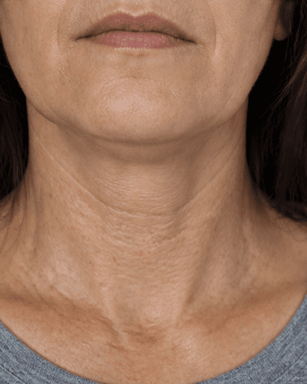 Intimate Laser Therapy: before
