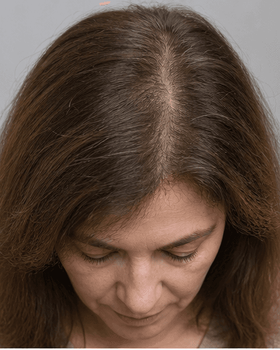 Female Hair Thinning Review: after