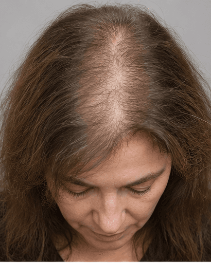 Female Hair Thinning Review: before