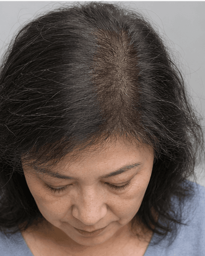 Female Hair Thinning Review: after