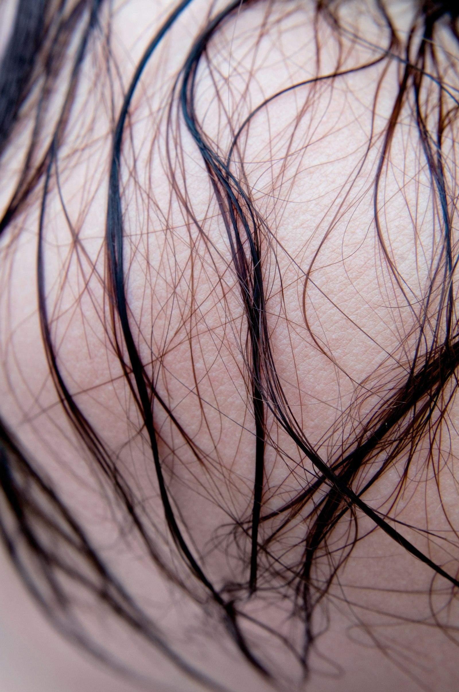 Hair Fall Diagnostics
