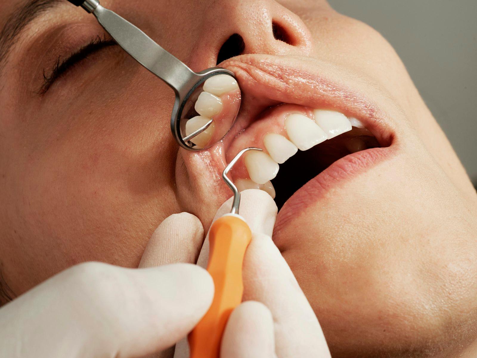Professional Whitening