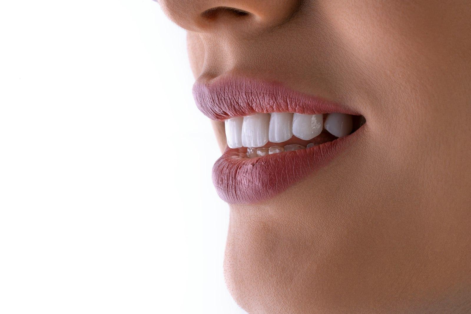 Clear Aligners