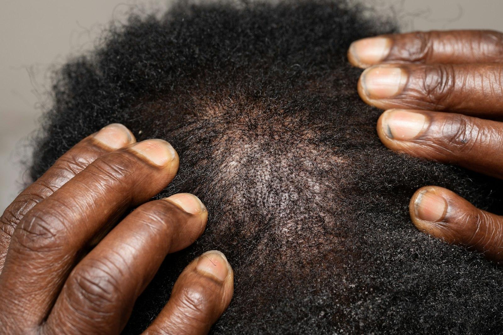 PRP Scalp Therapy